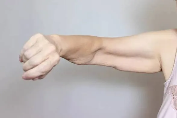 A thinner, softer arm with loose skin — what it looks like when the body lets go of muscle, not just fat